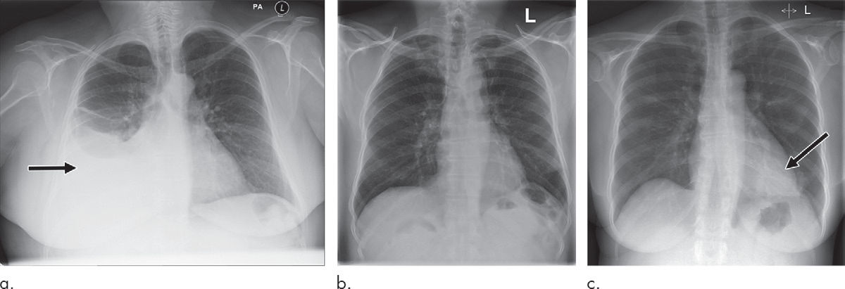 Examples of radiographs that were correctly and incorrectly prioritized by the AI system