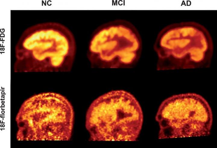PET imaging using FDG and florbetapir to quantify cognitive decline in patients with Alzheimer